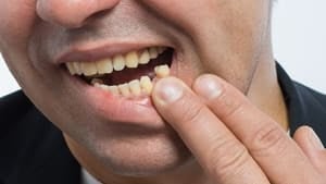 Avulsión dental dientes fracturados